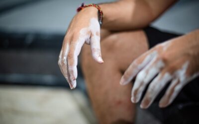 Jak skutecznie zlikwidować ciemne plamy na kolanach?